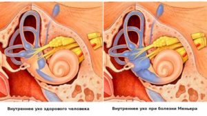 Болезнь Меньера (продолжение...)