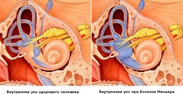 Болезнь Меньера (продолжение...)