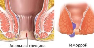 Геморрой или анальная трещина? Кровь на бумаге.