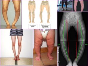 плоско-вальгусные стопы и антеторсия бедер