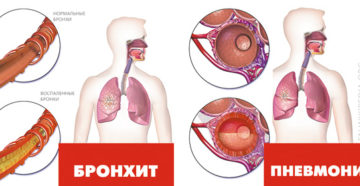 Бронхит или ветряночная пневмония ?