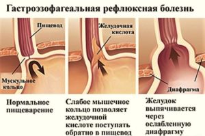 Изжога и гастроэзофагеальная рефлюксная болезнь (ГЭРБ)