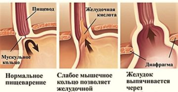 Изжога и гастроэзофагеальная рефлюксная болезнь (ГЭРБ)