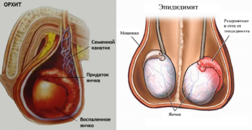 закатывания правого яичка вверх