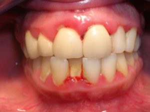 Симптомы болезни - зубные боли