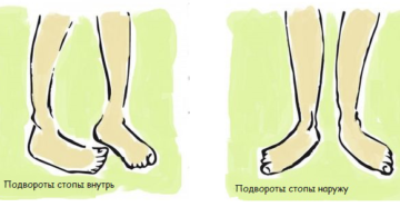 Подворачивается стопа при ходьбе у ребенка