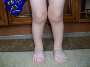 У ребенка при ходьбе подворачивается колено и не падает