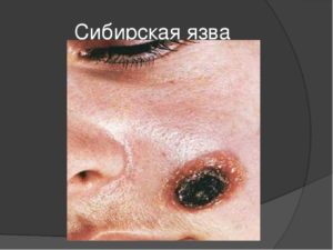 Anthracinum (Нозод сибирской язвы)