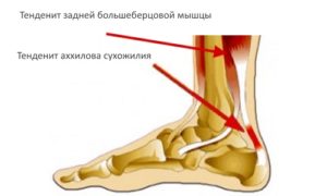 Тендинит задней большеберцовой мышцы