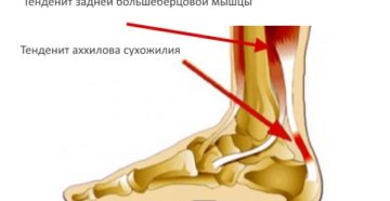 Тендинит задней большеберцовой мышцы