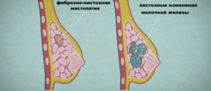 Фиброзно-кистозная трансформация лёгких