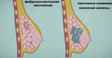 Фиброзно-кистозная трансформация лёгких