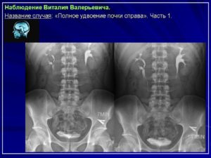 каликопиелоуретероэктазия правой почки