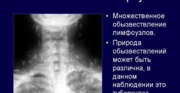 КТ-Признаки обызвествления внутригрудных лимфоузлов