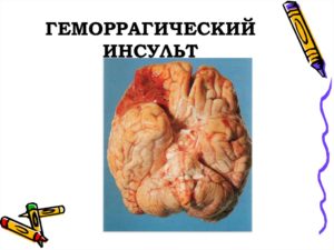 Геморрагический инсульт