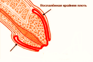 Опухоль на крайней плоти