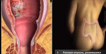 кровь после анального секса