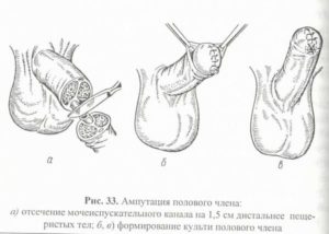 Частичное онемение полового члена