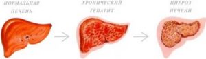 Хронический гепатит