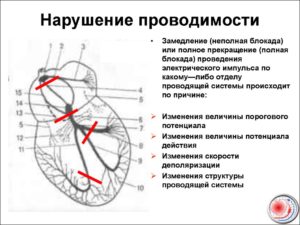 Симптомы болезни - нарушения желудочковой проводимости