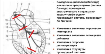 Симптомы болезни - нарушения желудочковой проводимости