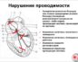 Симптомы болезни - нарушения желудочковой проводимости