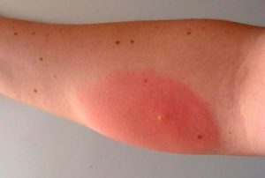 Аллергическая реакция на укусы насекомых