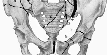 Повреждения костей таза