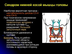 Осложнения остеохондроза – головная боль и синдром нижней косой мышцы головы