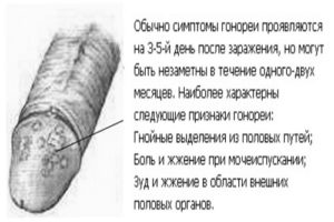 Симптомы болезни - боли в половом члене