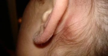 Воспаление лимфоузлов за ухом