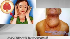 Симптомы болезни - нарушения щитовидной железы