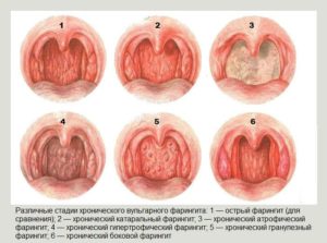 Хронический фарингит