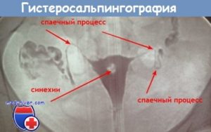 приём боровой матки при непроходимости маточных труб