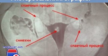 приём боровой матки при непроходимости маточных труб