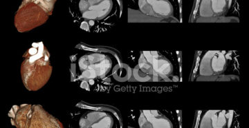 Компьютерная томография (КТ) сердца