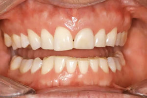 Скрежетание зубами (бруксизм)