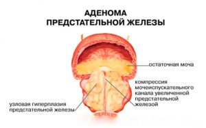 Лечение ГППЖ аденормом