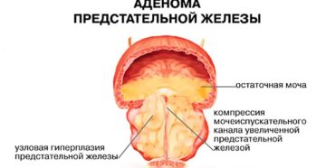 Лечение ГППЖ аденормом