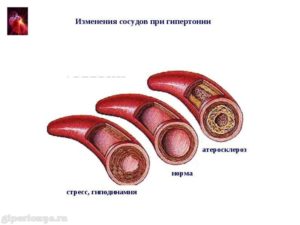 Гипертония: Высокое артериальное давление и атеросклероз