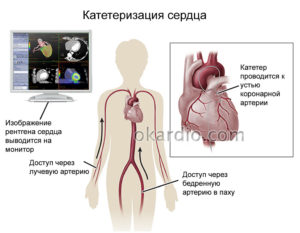 Катетеризация сердца