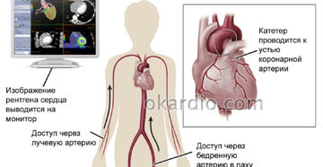 Катетеризация сердца