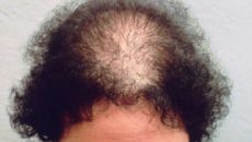 Реактивное выпадение волос