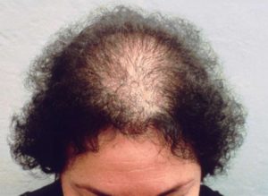 Реактивное выпадение волос