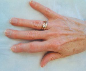 Симптомы болезни - боли в пальце