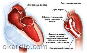 Уплотнение дуги аорты