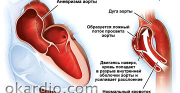 Уплотнение дуги аорты