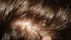 Шелушение кожи головы и выпадение волос