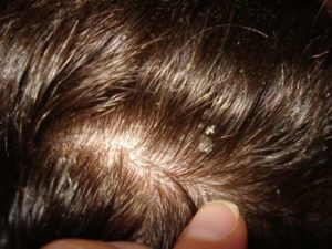 Шелушение кожи головы и выпадение волос