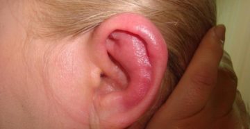 Воспалительные заболевания наружного уха
